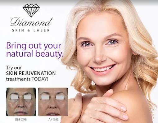 Laser hair removal Toronto North York at Diamond Skin and Laser.