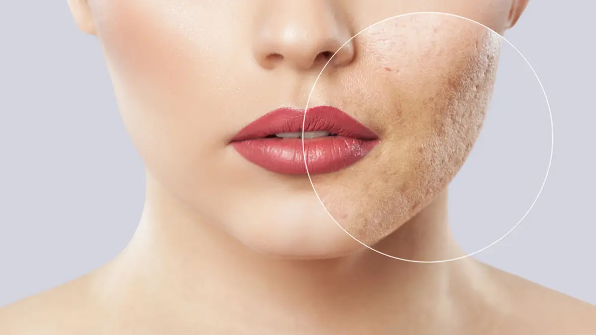 Acne Treatment