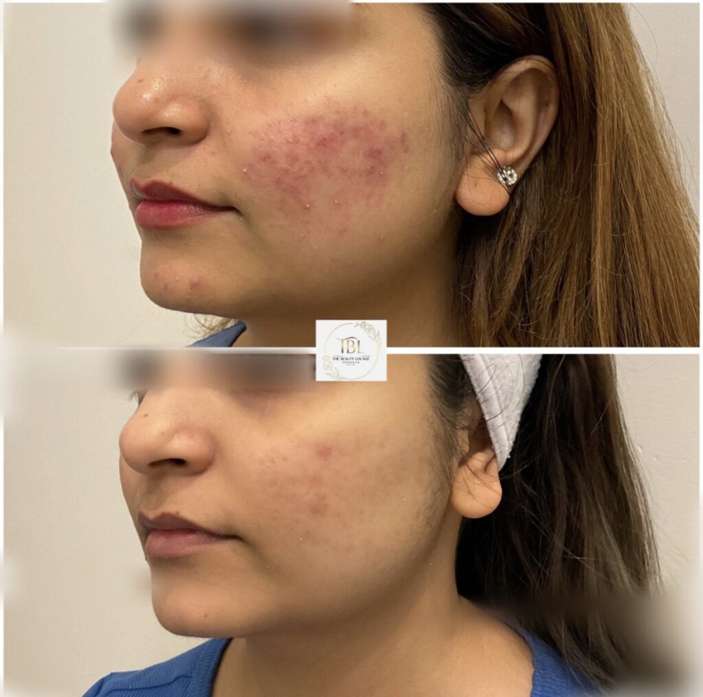 Acnelan Treatment