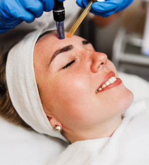 Microneedling with PRP