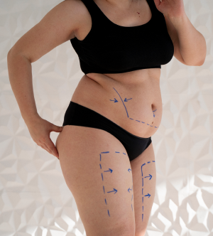 Non-Surgical Fat Reduction