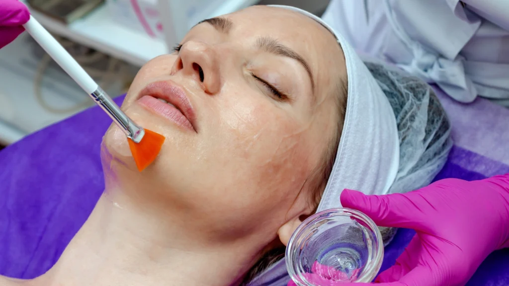 Acnelan peel for acne prone skin treatment benefits.
