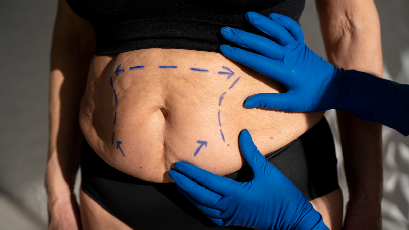 What effects body contouring Toronto cost for different treatment areas.