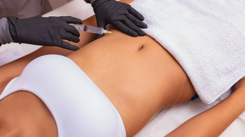 Adipose lipolysis injection procedure for targeted fat breakdown.