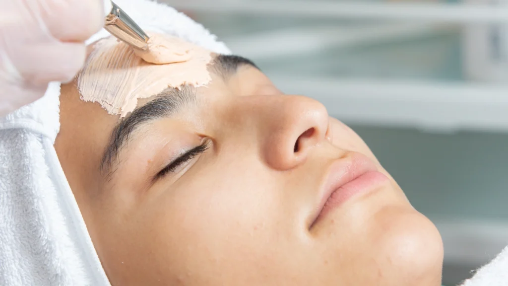 Acnelan peel price in Toronto information for acne treatment patients.