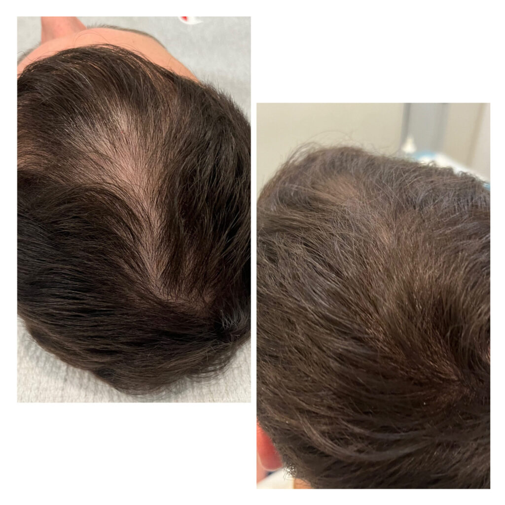 PRP Treatment