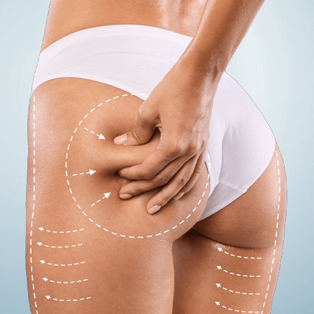 What is Cellulite Reduction?