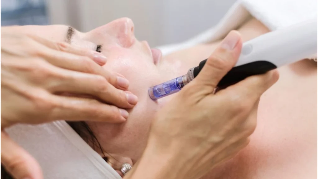 Know the standard microneedling cost Toronto.