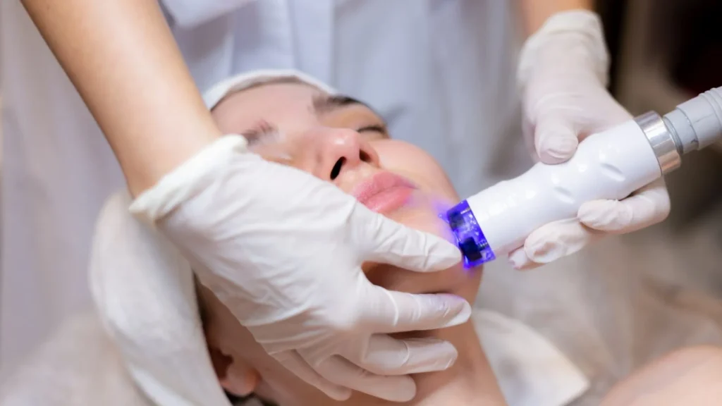 Rf microneedling cost Toronto.