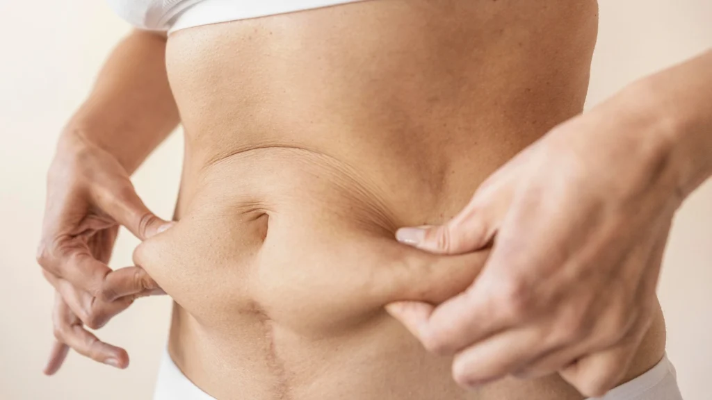 Stubborn fat persistence and lipolysis naturally.