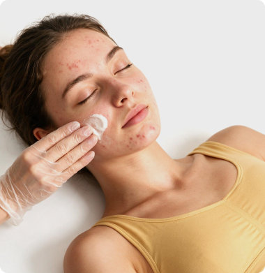 Acne Facial 