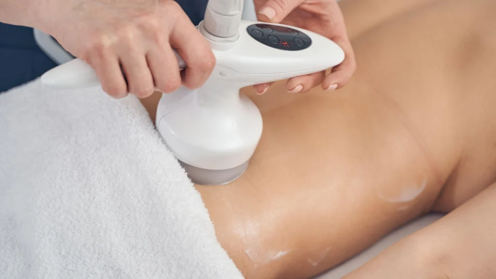Non-invasive ultrasound lipolysis treatment.