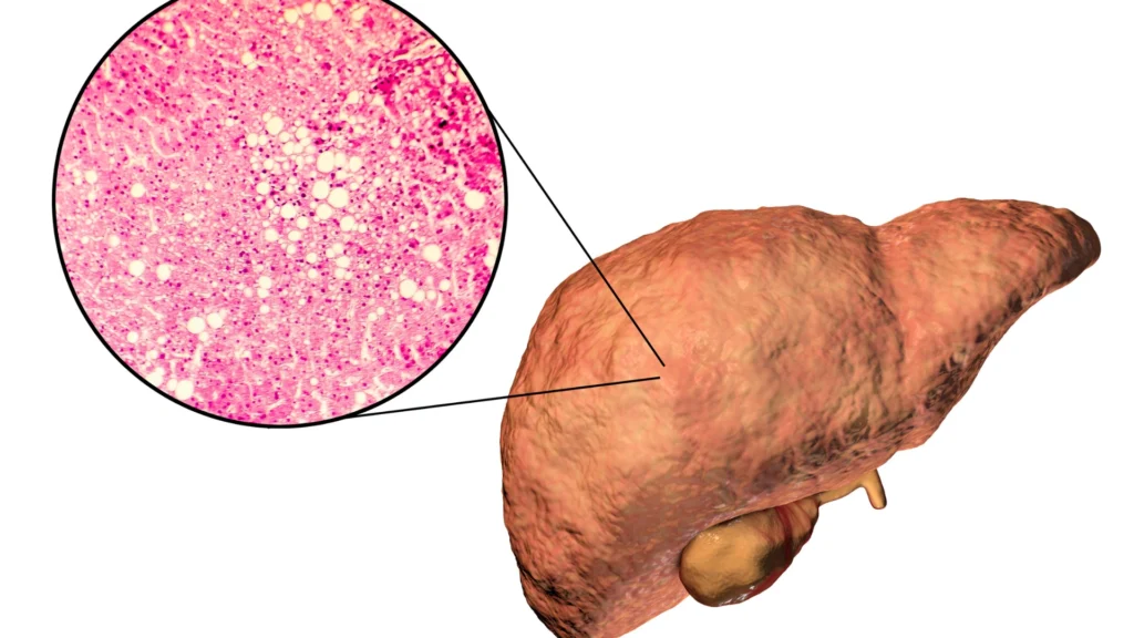Effect of retatrutide lipolysis on liver fat metabolism. 
