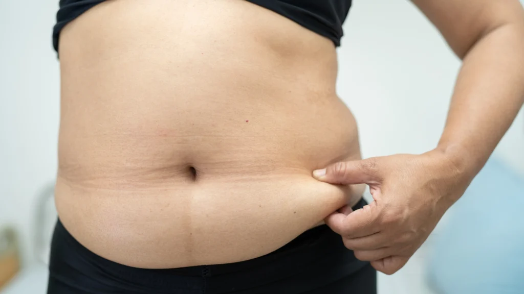 Good candidate for ultrasonic lipolysis.