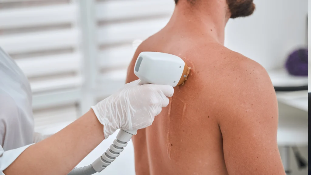 Common full back laser hair removal options in Toronto.