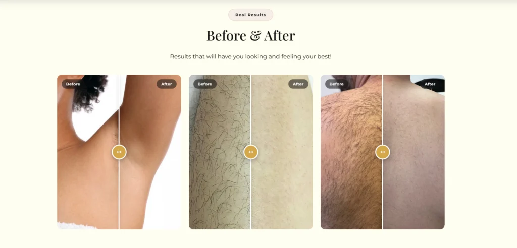 Laser hair removal treatment experience and technology.