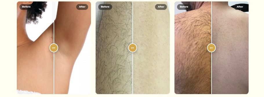 The Beauty Lounge Toronto - laser hair removal treatments in Toronto.